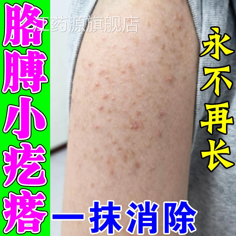 胳膊上起小疙瘩手臂毛囊炎专长痘痘鸡皮肤去除毛囊角化角质药膏江