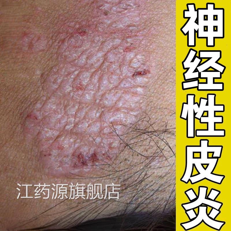 皮藓治疗牛皮癣银屑病皮肤去湿疹顽止瘙痒根特神经性皮炎专外用膏