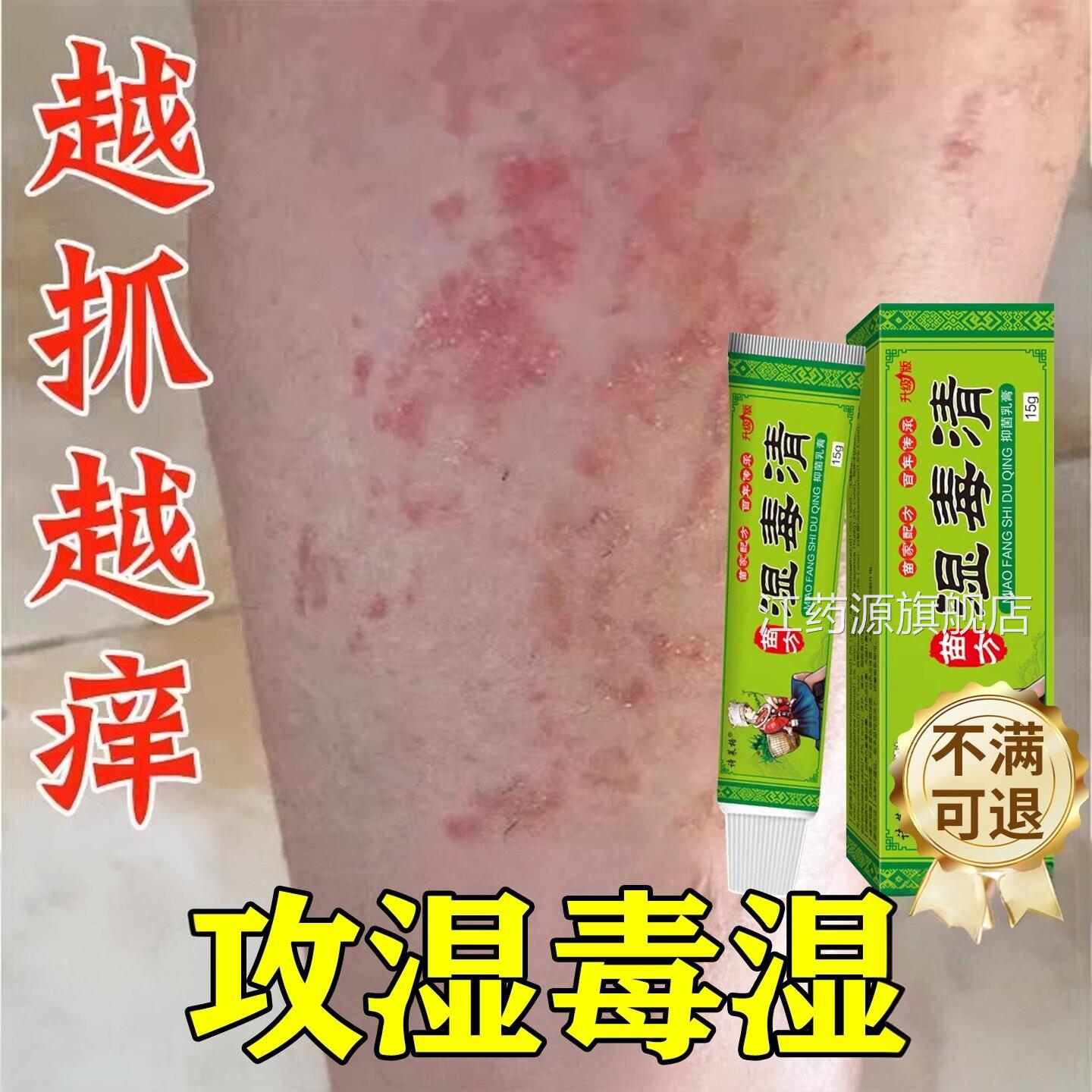 湿毒清软膏湿热止湿痒祛痒根皮肤皮除瘙炎痒水泡治湿用膏江药源旗