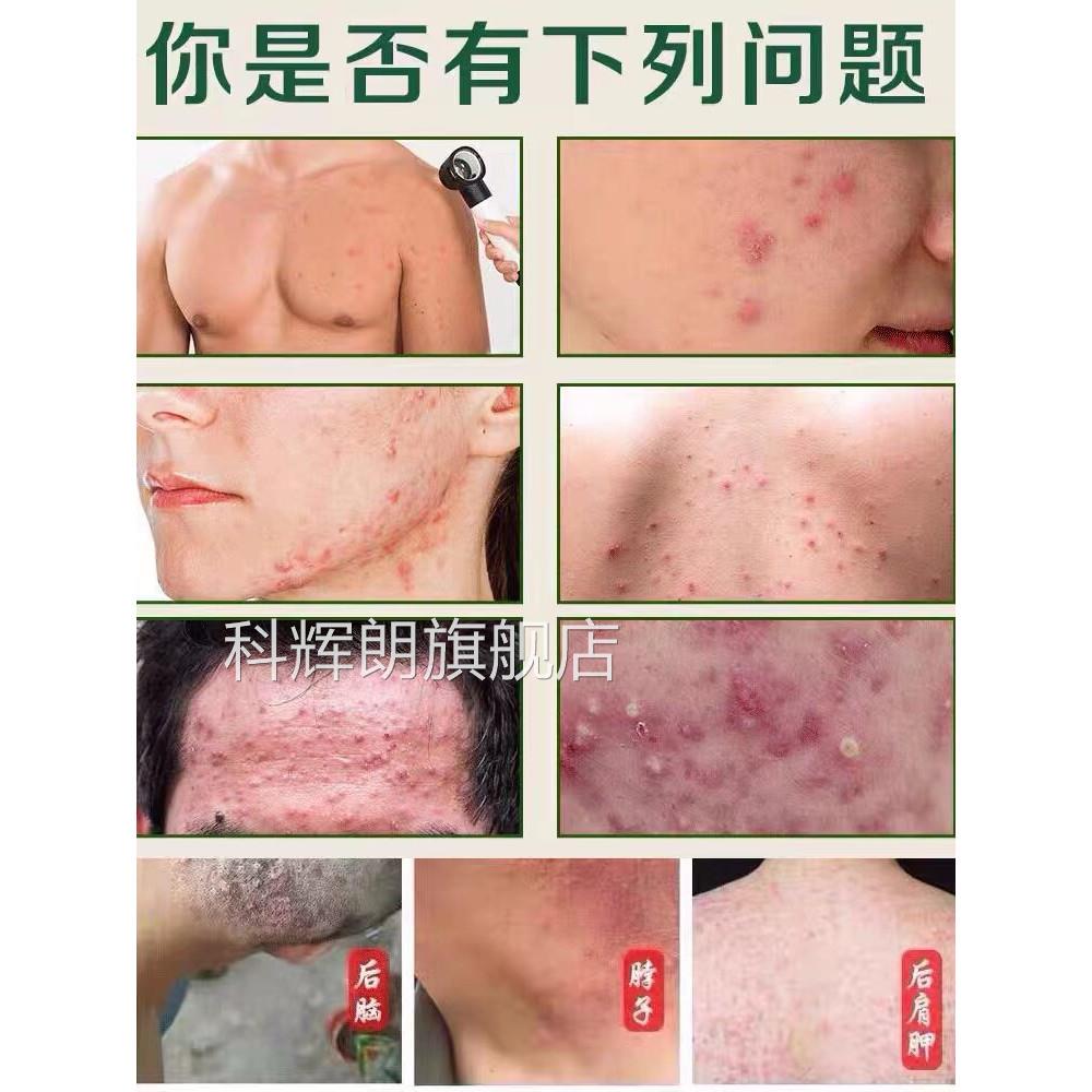 马拉色菌膏头皮膏 药头上脖子前胸后背痘疙瘩痘糠秕孢子真 菌科辉