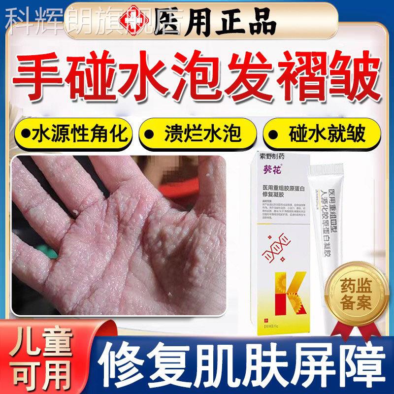 手碰水泡发起褶皱发白水性肢端角化症开裂口手指源脱皮湿疹手癣TK