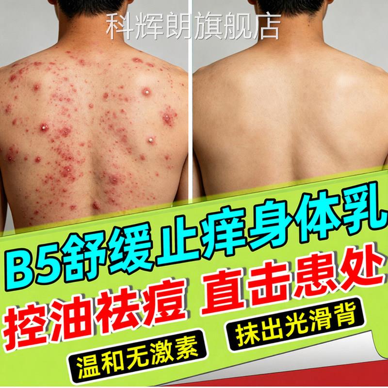 马拉色菌前胸后背部祛痘过氧化苯酰身体乳粉末黑印涂抹身体甲乳膏
