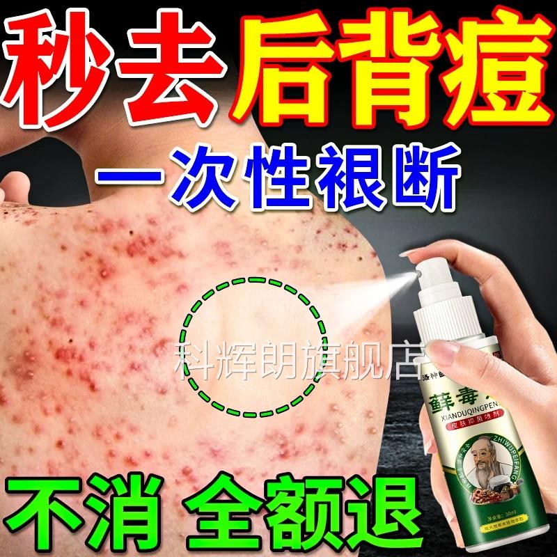 后背祛痘喷雾去上除前胸背痘痘螨虫毛囊炎疙瘩痤疮止痒效特喷剂药