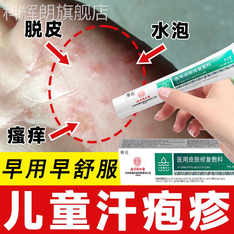 儿童汗疱疹手痒除起水泡去汉状真菌感染根汗状疱疹湿止痒药膏TO科