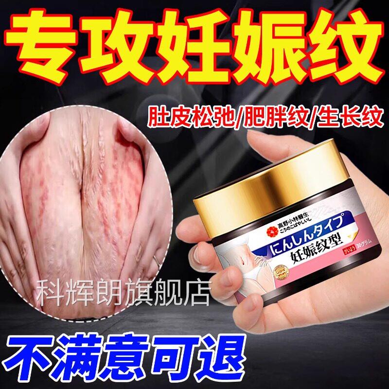 去肥胖纹修复霜消生长纹除大腿学生青少年妊专用去辰娠纹修复膏科