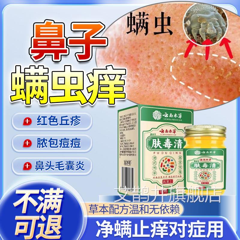 鼻子螨虫外面痒毛囊炎长瑰红痘脱皮鼻翼两测泛红酒糟鼻玫痤疮u9艾
