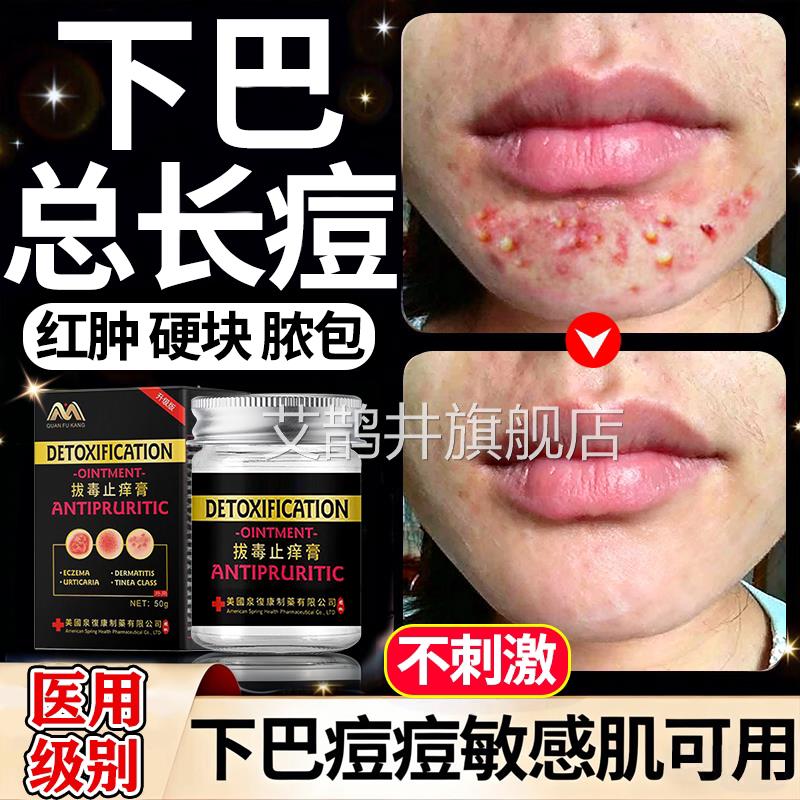 下巴反复长痘疮淋巴痘腮边痘玫瑰痤疮屏障修复脓包型重度暗脸上痘