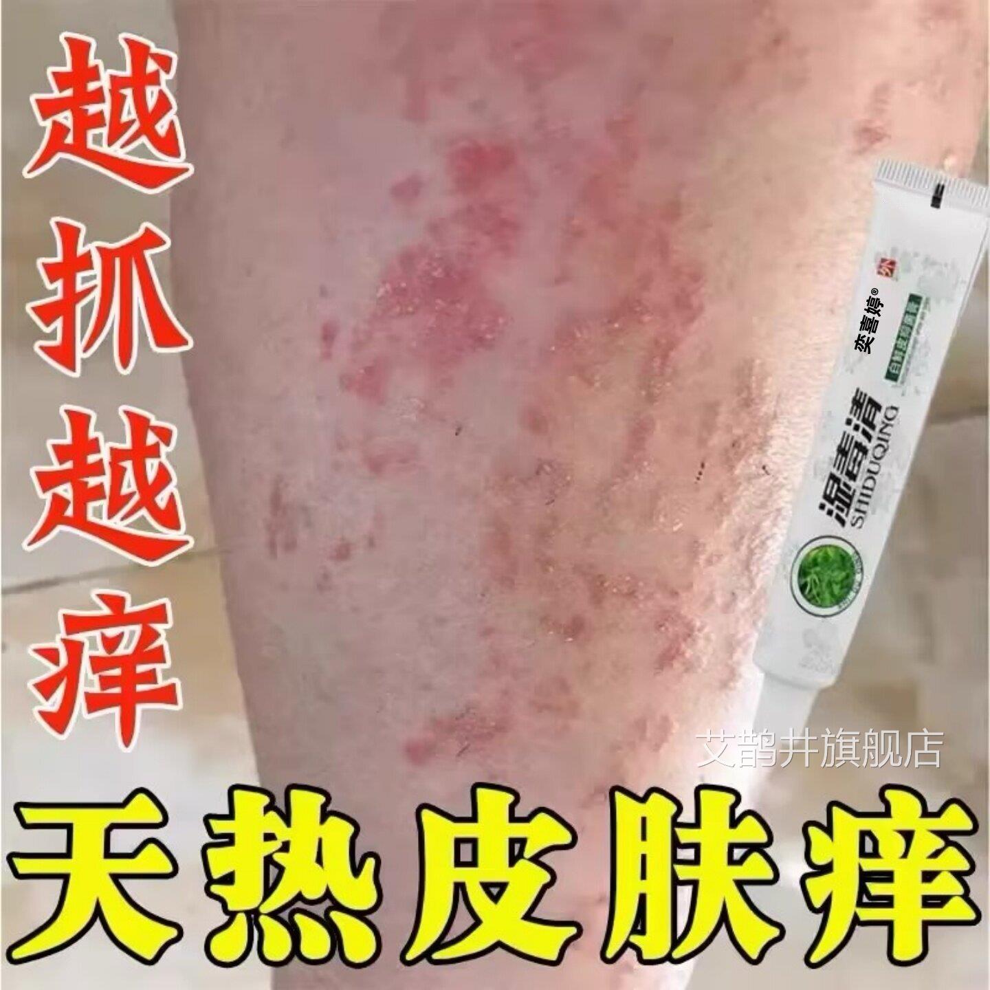 夏天小腿痒湿成人膏出汗身上止痒天热皮肤疹瘙痒热疙瘩红疹热毒痒