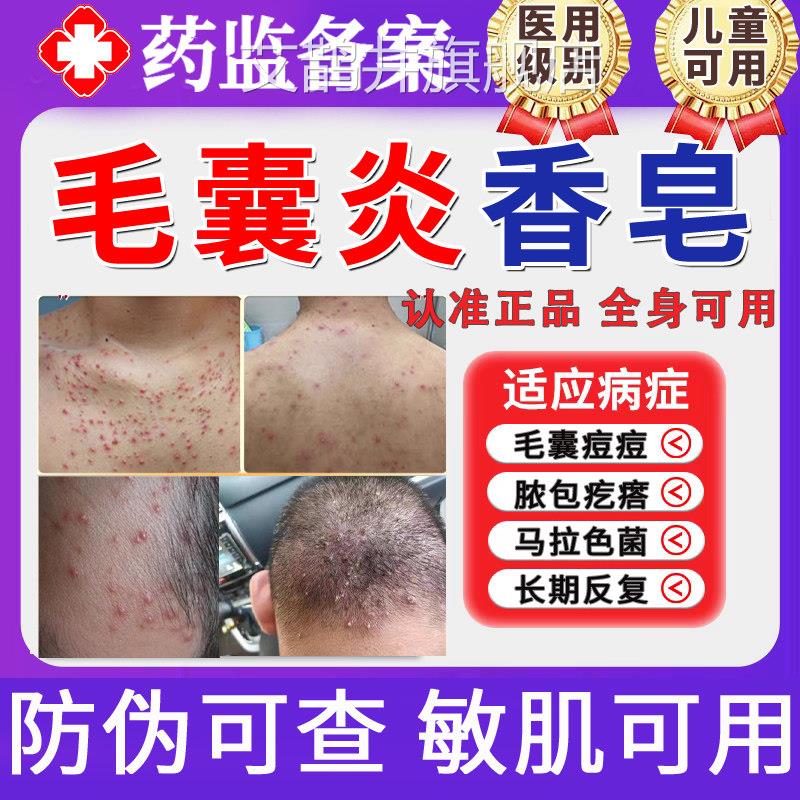 硫磺毛囊皂炎香皂马拉色菌药背上后背长痘痘除螨祛痘痒疼沐浴露TT