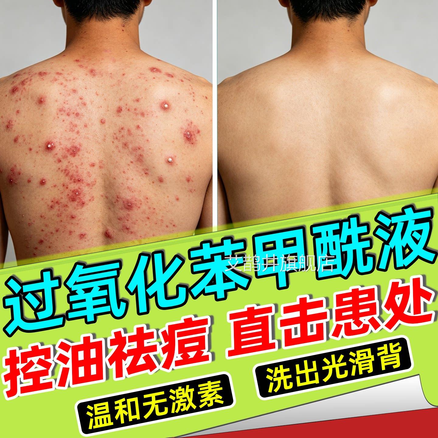 控马拉色菌前胸后背部祛痘沐浴露身体乳洗液粉末黑印沐浴露溶剂油