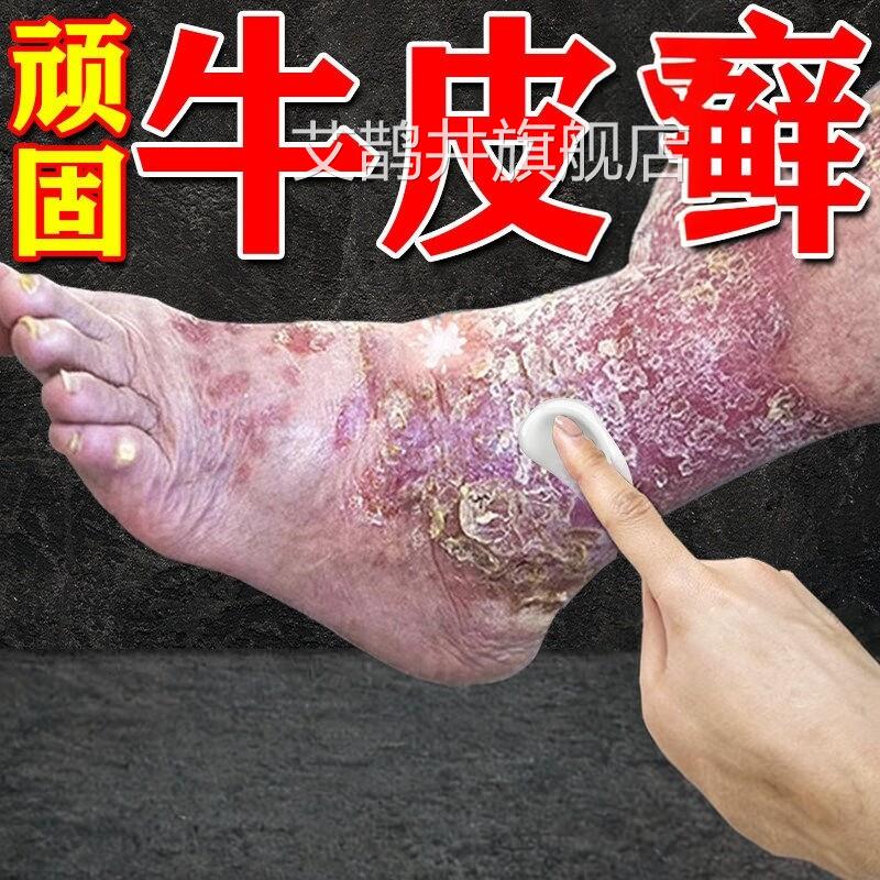 日本口疗顽固性牛皮银进屑效用膏药皮肤真菌感染杀菌艾鹊井旗舰店