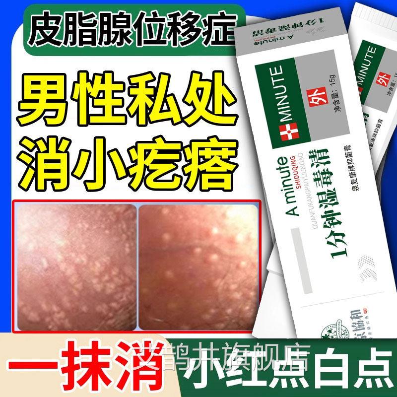 皮生脂腺异位症阴茎阴囊包皮皮脂腺异位生殖器增毛囊炎小疙瘩丘疹