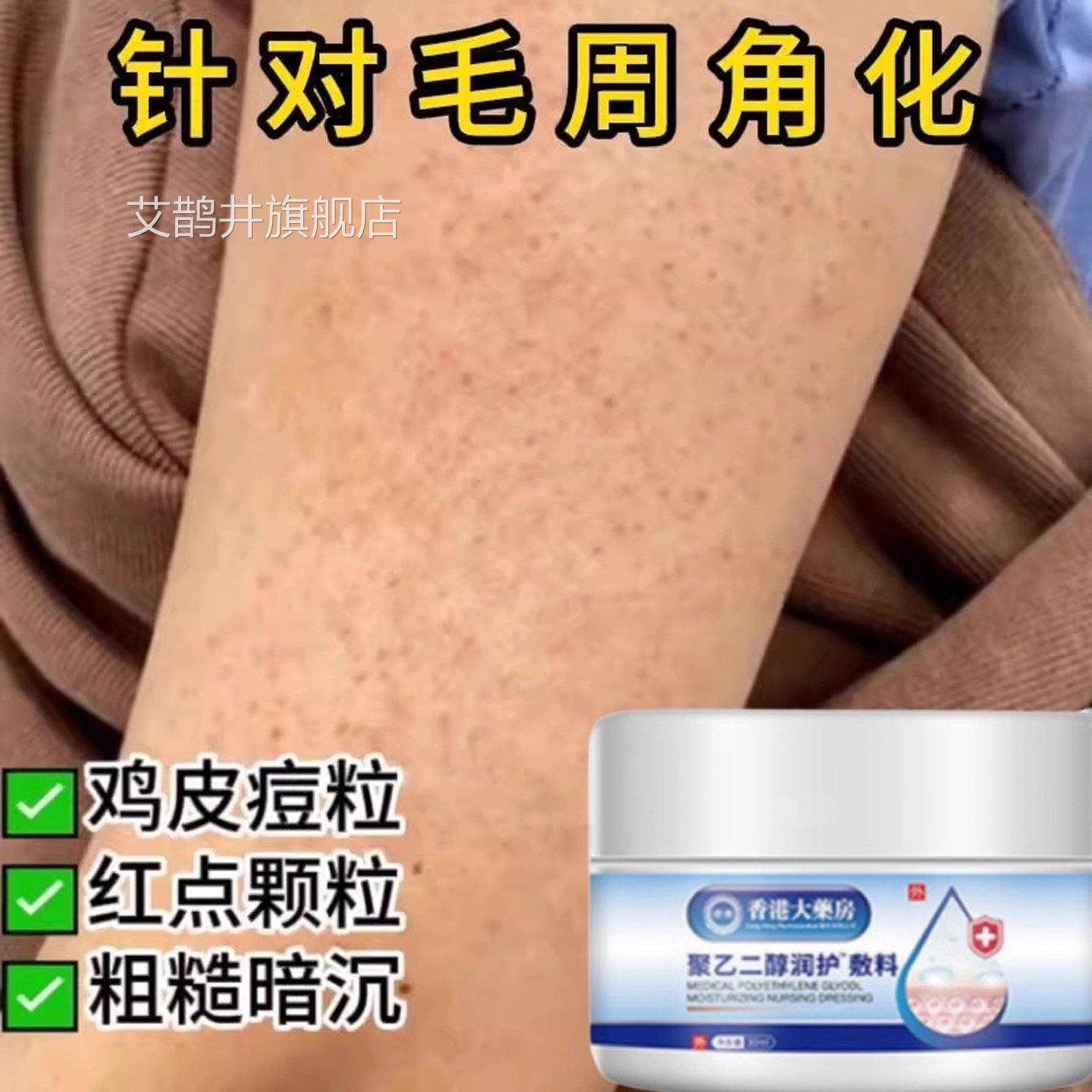 医用儿童鸡皮肤疙瘩毛囊角化症手足脱小颗粒去皮除面部角质敷料艾