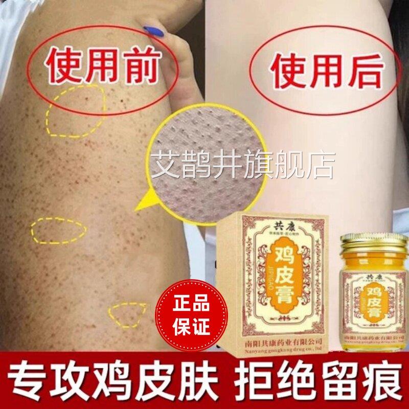 鸡皮肤疙瘩毛囊角化症去除神器全手臂腿专改善胳身膊上长疙瘩用膏