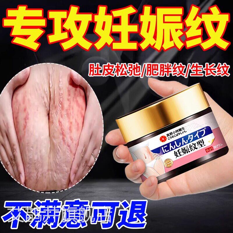 去肥胖纹修复霜消生长纹除大腿学生青少年专用去辰妊娠纹修复膏艾