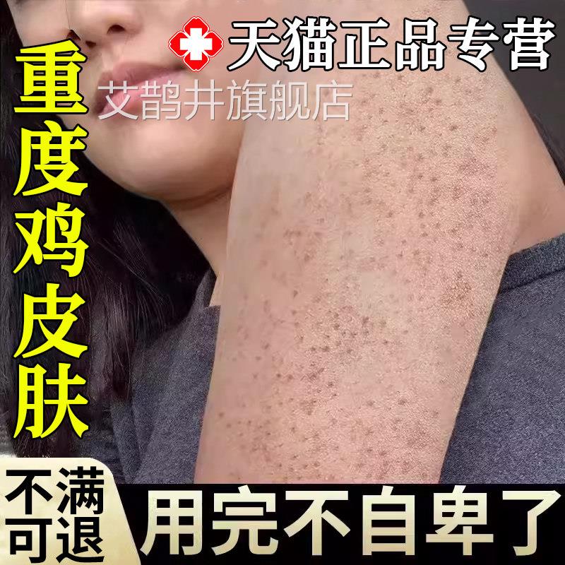 鸡皮肤疙瘩毛囊角化症专用膏药贴膏M手臂毛囊炎胳膊上长疙H瘩艾鹊