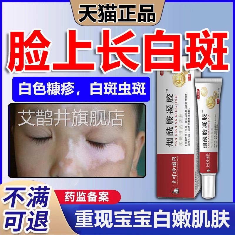 白色糠疹膏儿童脸p上长白斑专用玫瑰糠疹特去癣脸部皮肤瘙痒效1艾