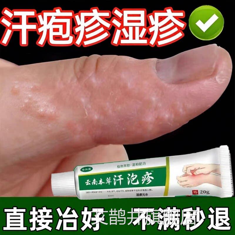 手上起小水泡汗泡疱止抑菌痒鹅掌风真菌用感染手气湿痒疹特专效膏