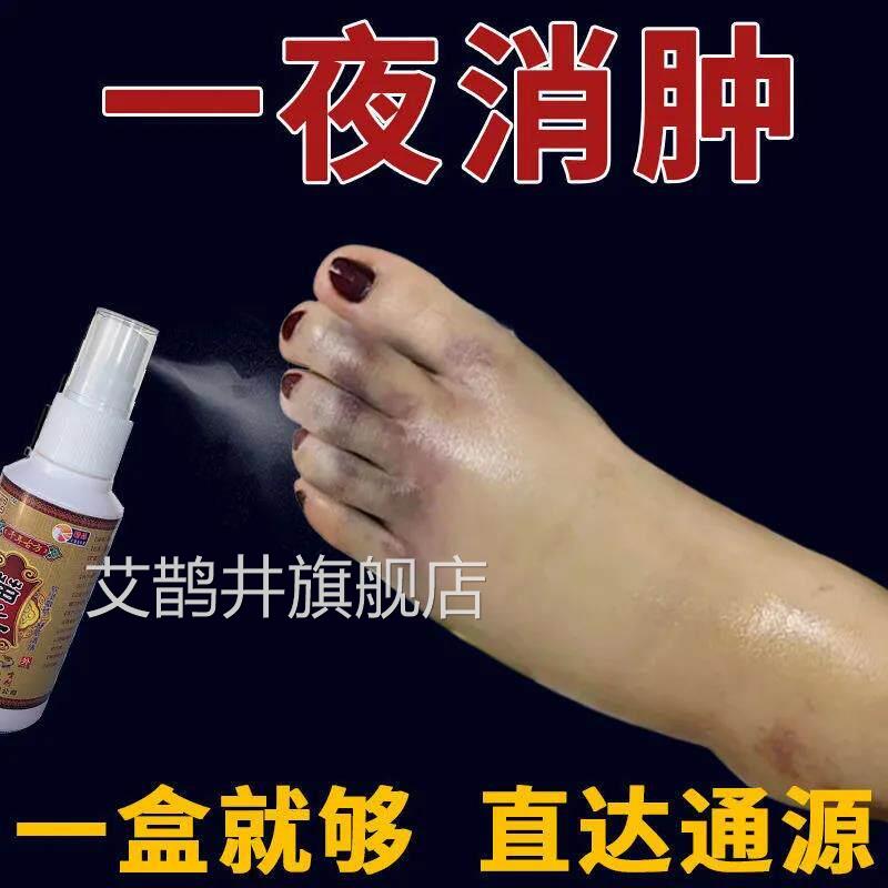 去水肿消肿特效专化用药老人脚肿消肿的药消肿止痛活血瘀喷雾剂艾