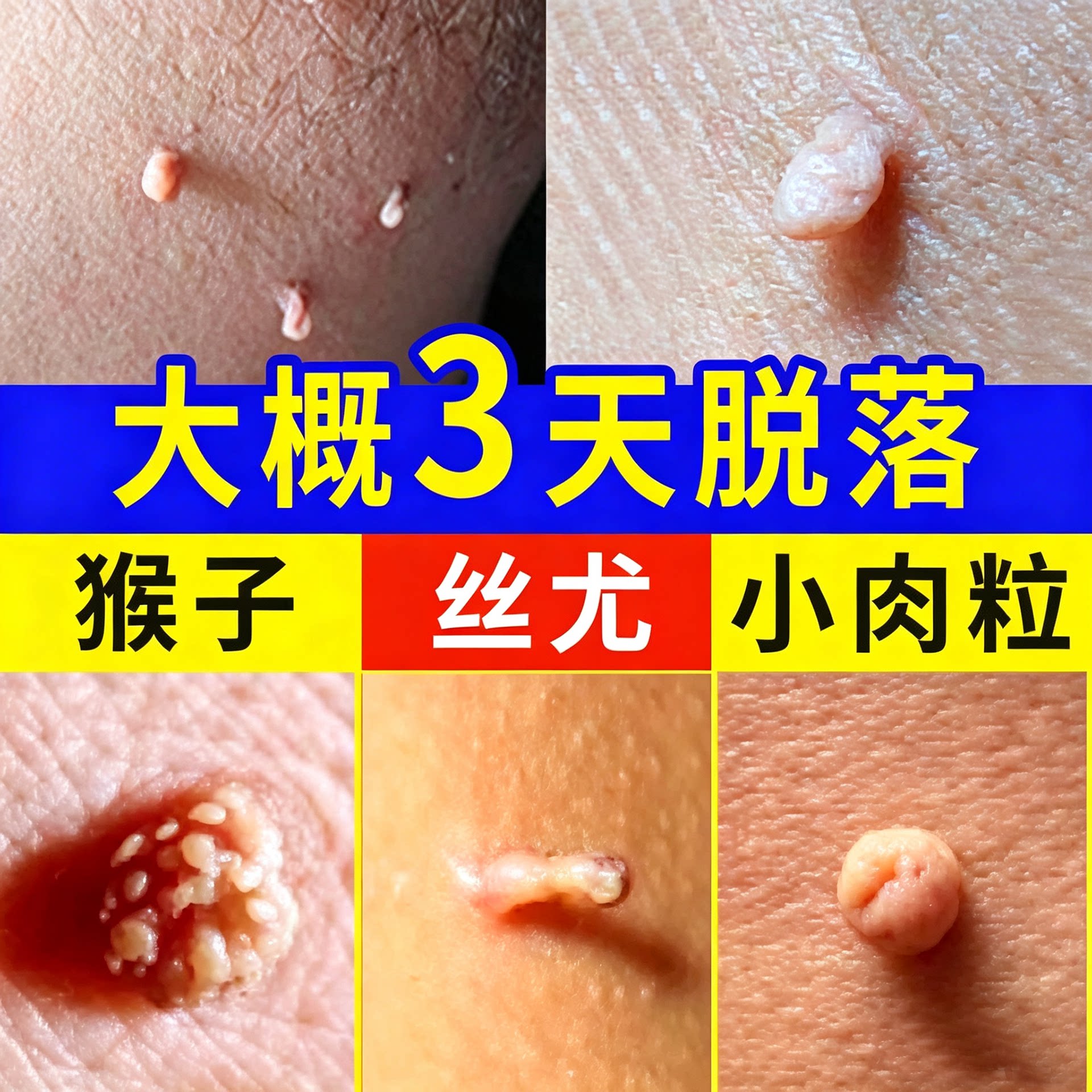 脖子上脸上胳肢窝猴子去尤瘊小肉粒疙瘩一抹无忧皮赘神器膏除