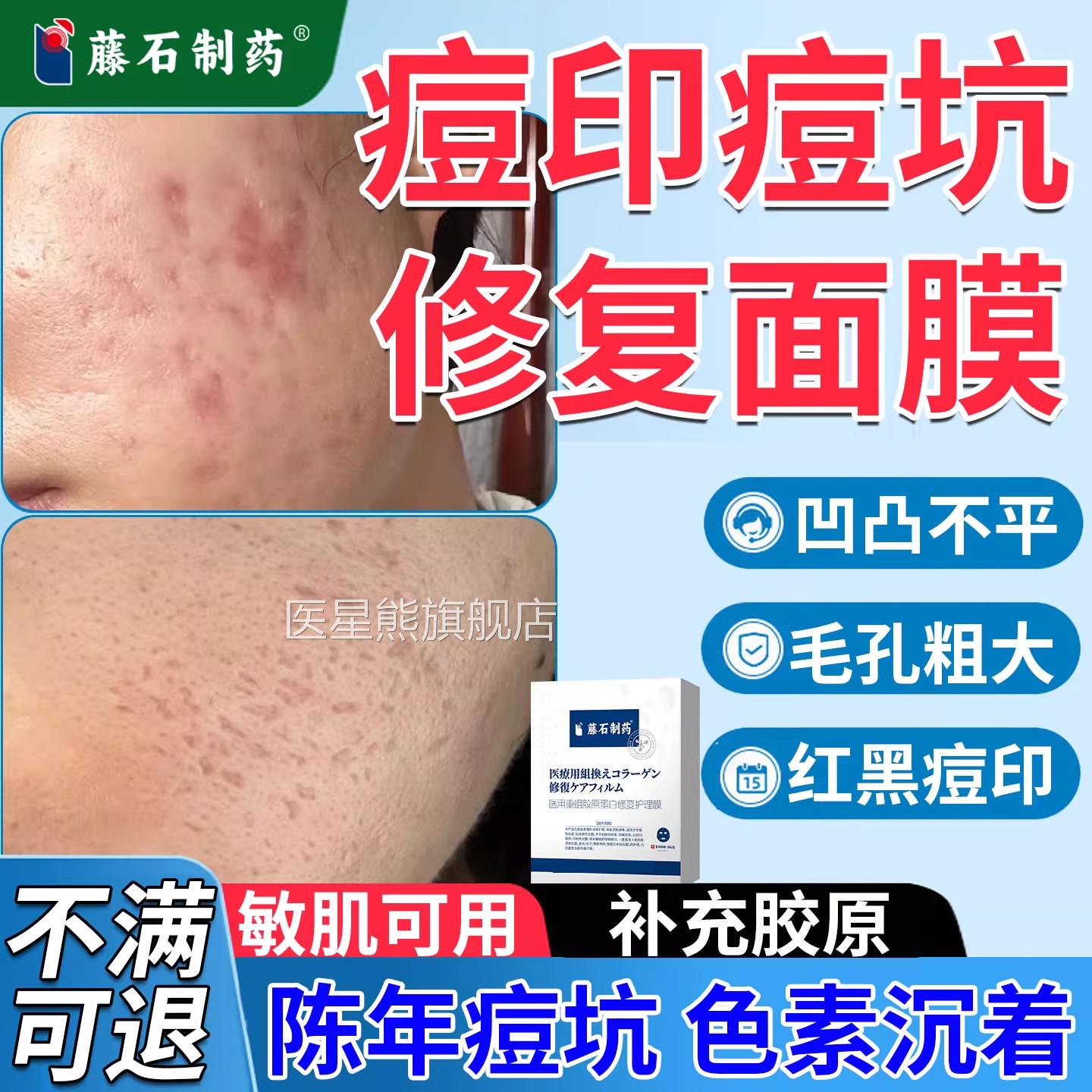 痘印痘坑修复去除精华面膜毛孔粗专用抗大炎消炎淡化祛痘印VX医星