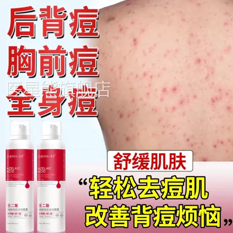 去除前胸背后长痘痘后背毛囊炎磺沐浴露马硫拉色菌上除螨祛痘痒医