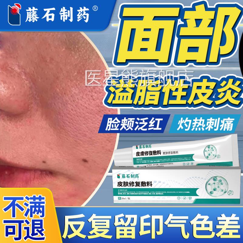 面部脂溢皮炎鼻翼两侧泛红瘙痒刺痛起皮马拉色菌感染皮肤修复T性Z