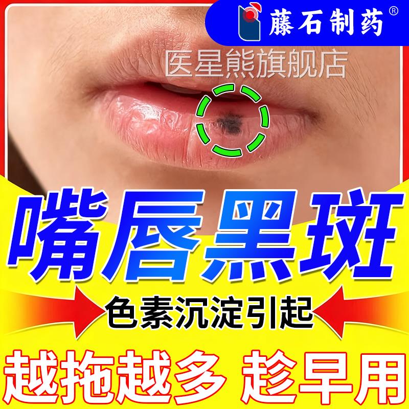 嘴唇黑斑黑点发黑去除分解淡化沉周围去黑色素着唇部护理医用型RW