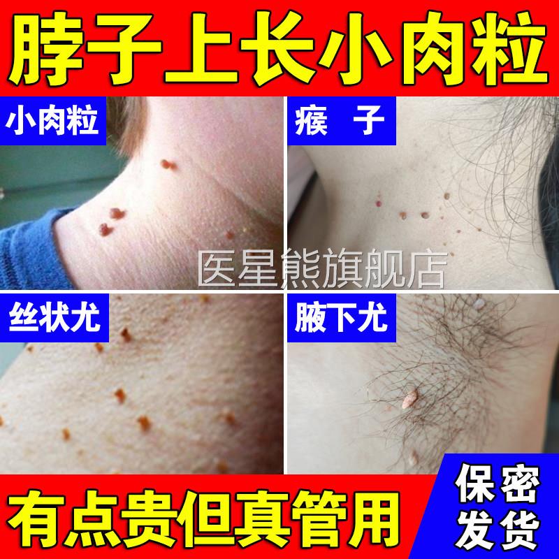 去疣瘊小肉粒扁平疣去除膏一抹灵疣去除神器疣立净正品官舰方旗店