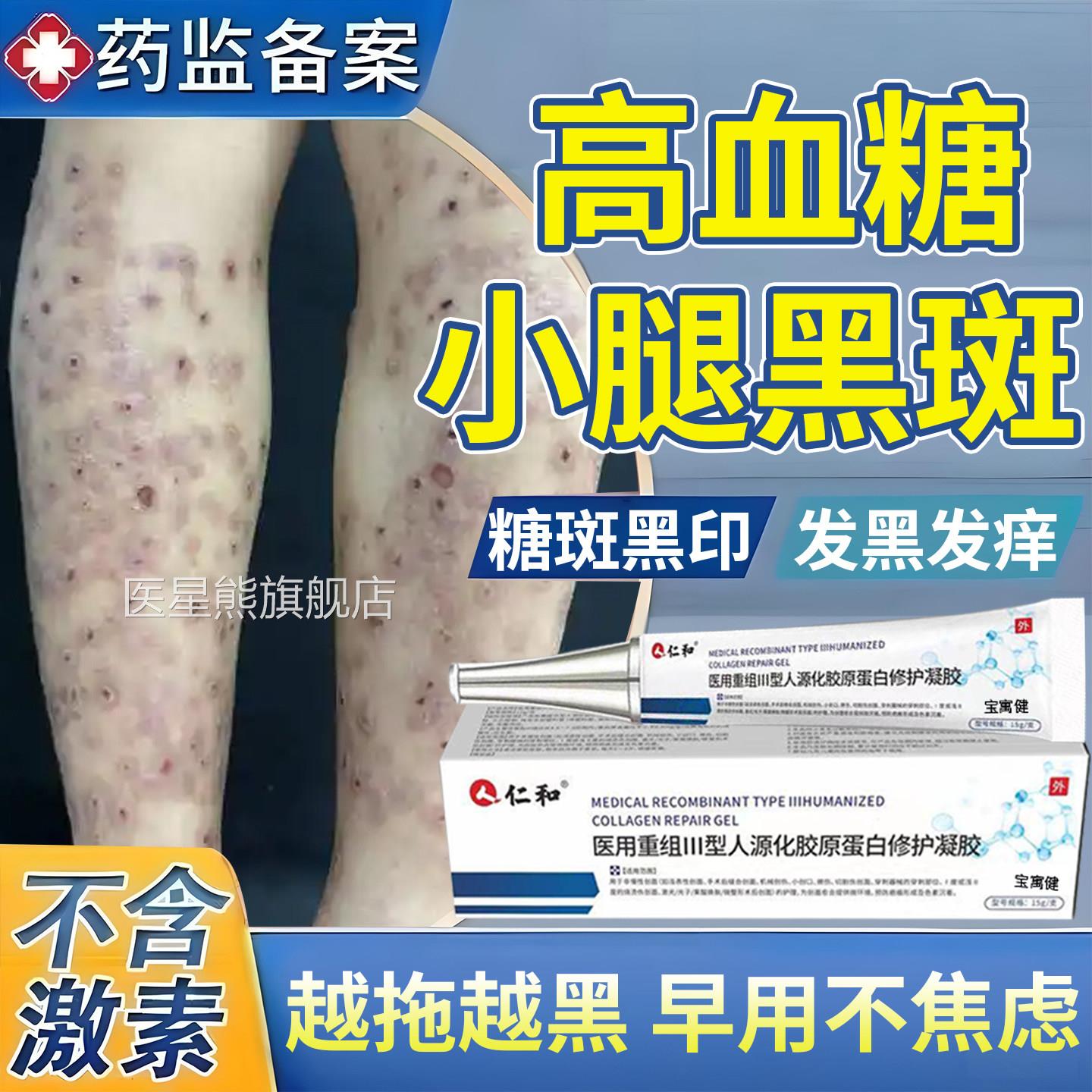 糖尿病疤痕印引小腿黑斑去胫前除起腿上糖斑皮肤痒色素沉着烂足膏
