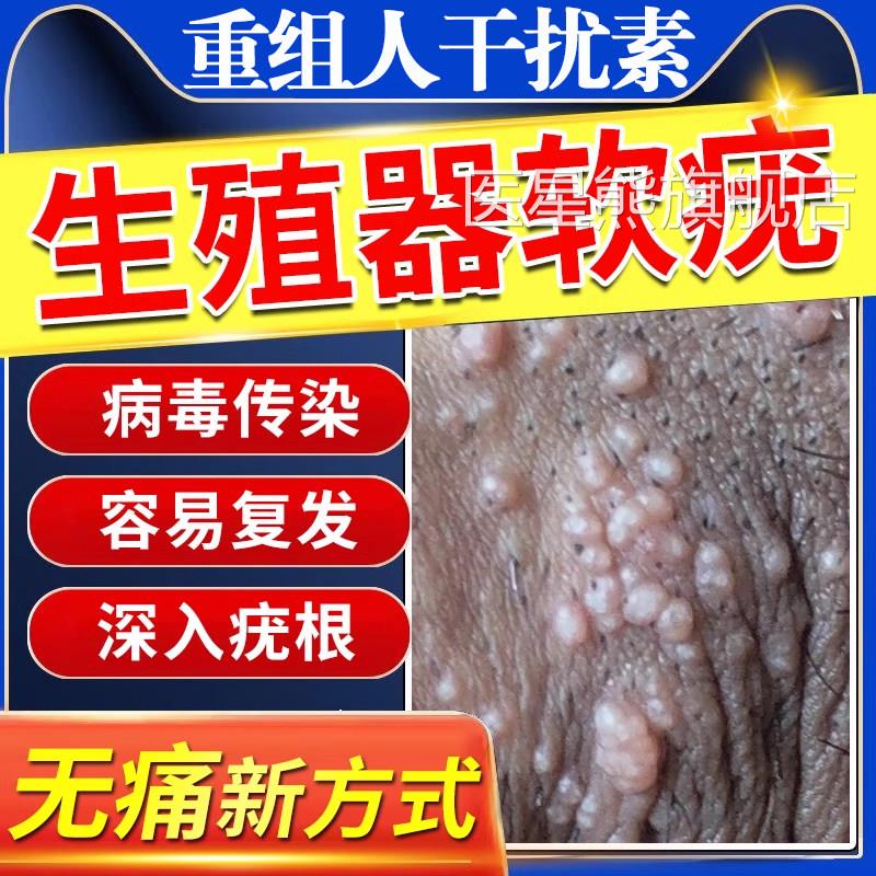 传染性软疣软尤去疣膏扁平疣病膏毒除小肉粒重组人干扰素a2d软rr