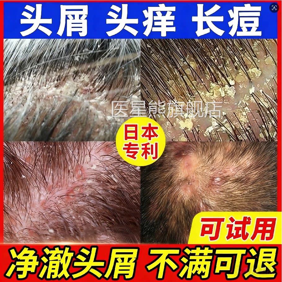 洗发水去屑止痒控油蓬松皮疙瘩头毛囊除螨炎洗发露男官方旗舰店Z