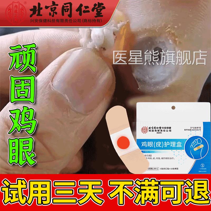 去顽固老鸡眼贴搭配膏药贴除神器去脚底趾跖疣灵茧肉刺药监备案OM