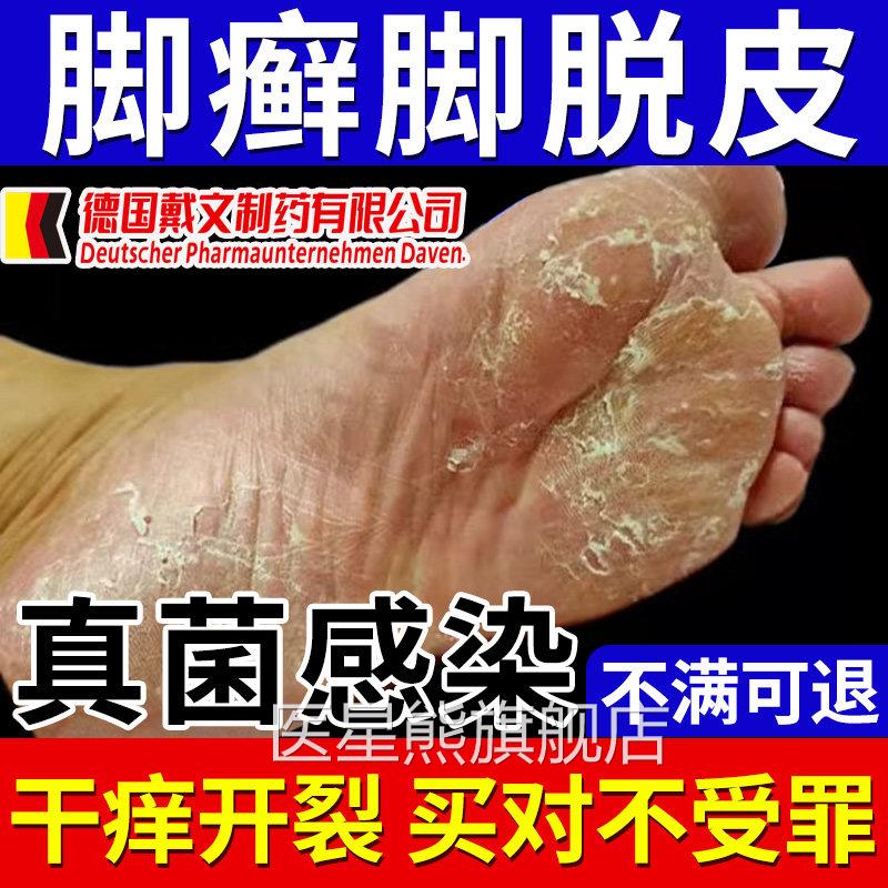 裂足脚癣一次净官方旗舰店脚气止痒脱皮真菌感染正品药监备案OM医