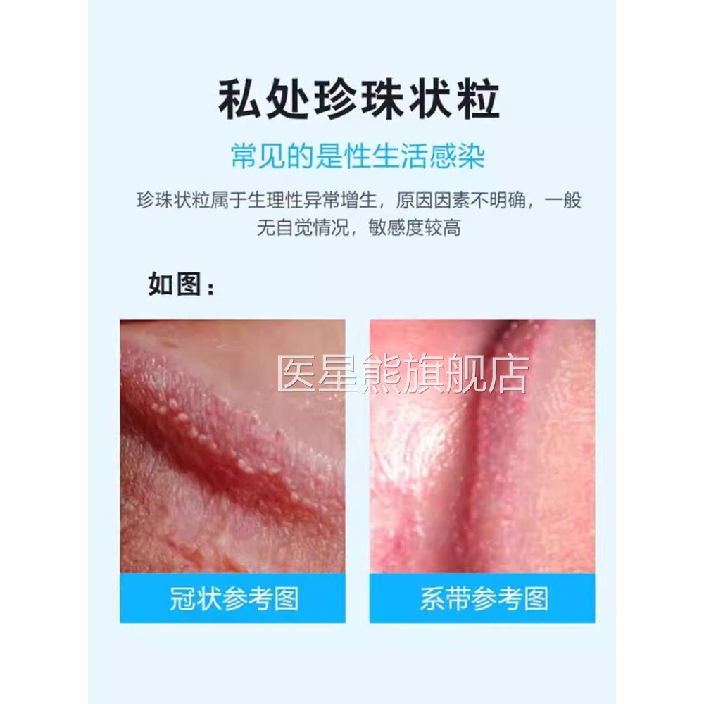 龟症头皮水泡下面珍珠状粒丘疹冠状沟皮脂腺异位豆腐渣白垢HB医星