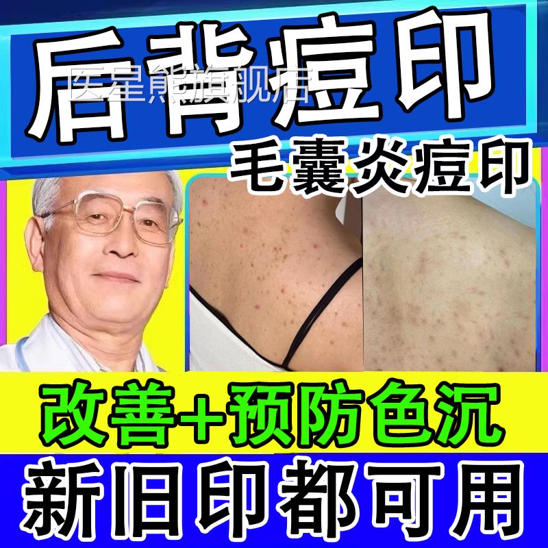 后皂背痘印黑色素沉淀去除前胸后背毛囊炎疤痕湿疹黑印硫磺去背痘