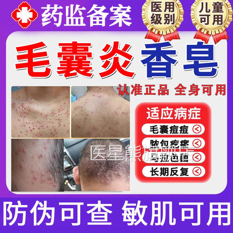硫磺皂毛囊炎香皂马拉色菌药背上后背长痘痘螨除祛痘痒疼沐浴露TT