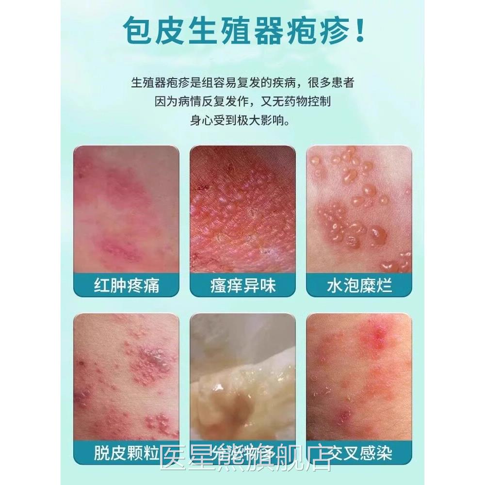 生殖疱疹男士器私密处疱疹阴茎真菌感染HB医星熊旗舰店