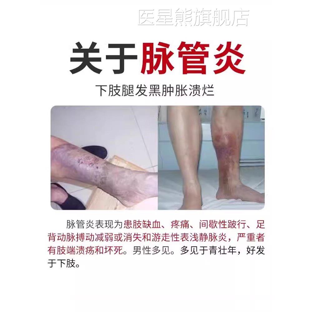 脉管炎特老烂腿专用静曲张小腿血栓烂足脉伤口愈合药房同款膏CA医