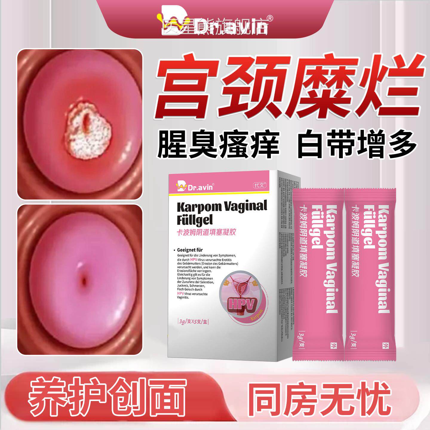 宫颈糜烂妇科凝胶肥大子宫内膜瘙息肉二度三度消糜栓痒抑菌BM医星