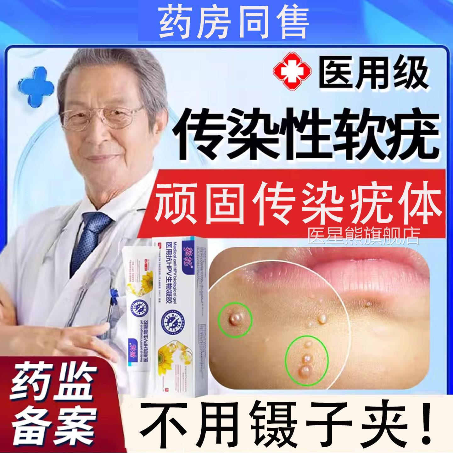 传染性软疣儿童宝宝成人去除药膏夹子镊子毒性水猴子软疣T病K医星