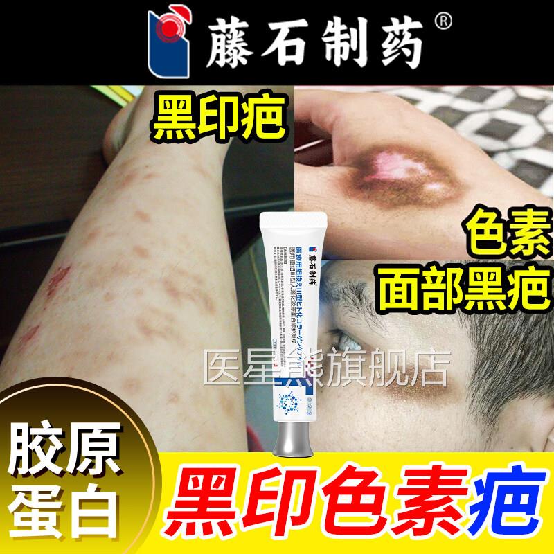 黑印色素沉淀去除疤膏疤痕修复痘印祛淡化修复医用硅酮凝胶色沉CA