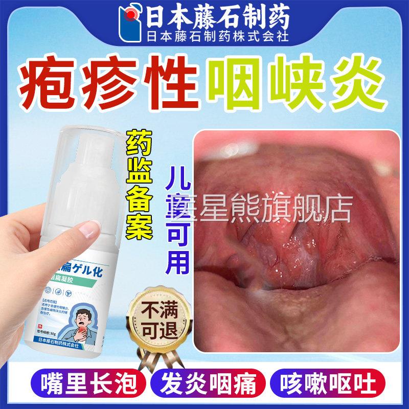疱疹性咽峡炎童喷雾剂咽喉炎慢性咽炎除根口腔疱疹儿咳嗽异物感OM