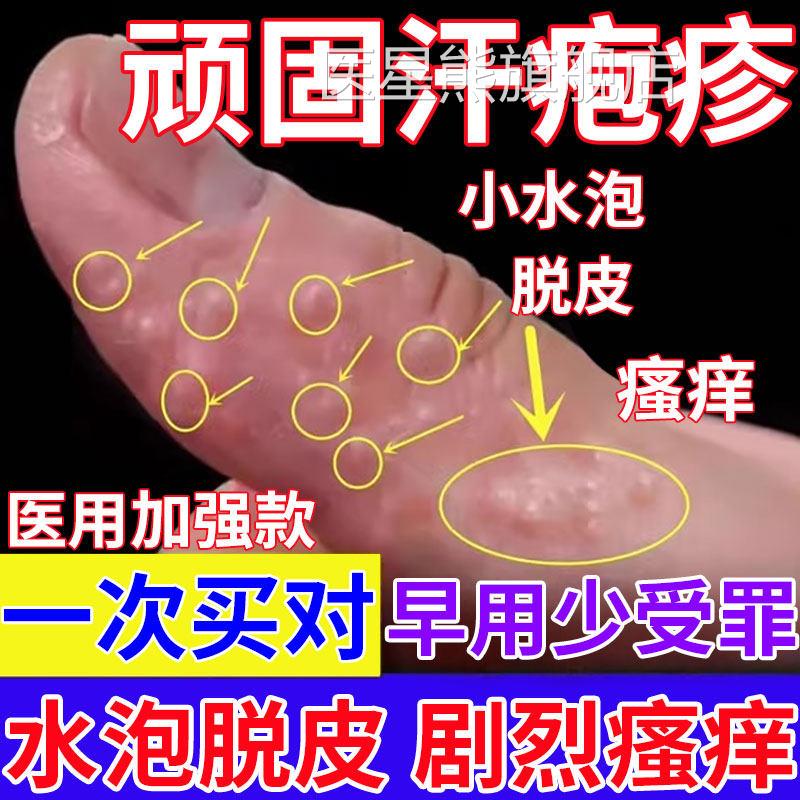 汗疱疹汗泡疱疹药房同款膏汗孢疹手起小水泡手上痒汗状湿疹止痒SK