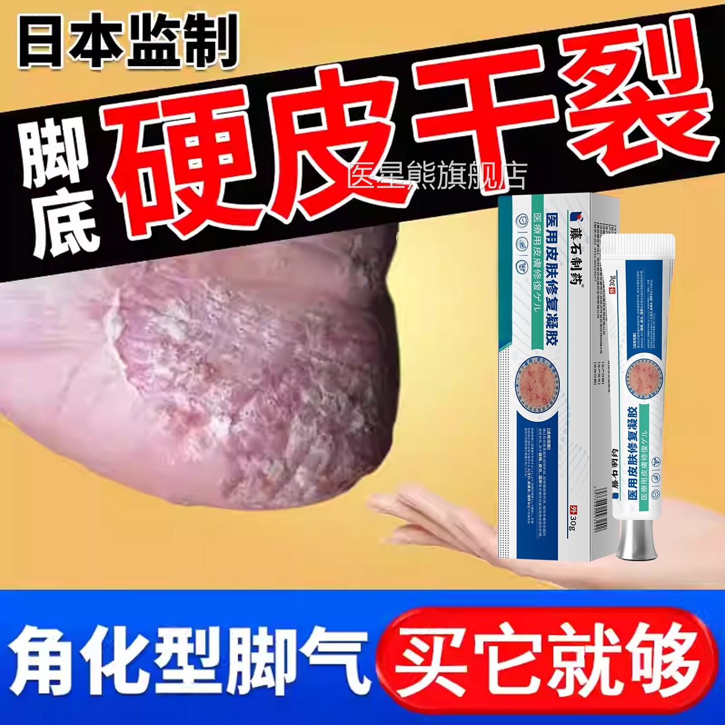 角感化型脚气脚后跟干裂真菌染湿疹膏药房同售起硬皮足跟开裂底SK