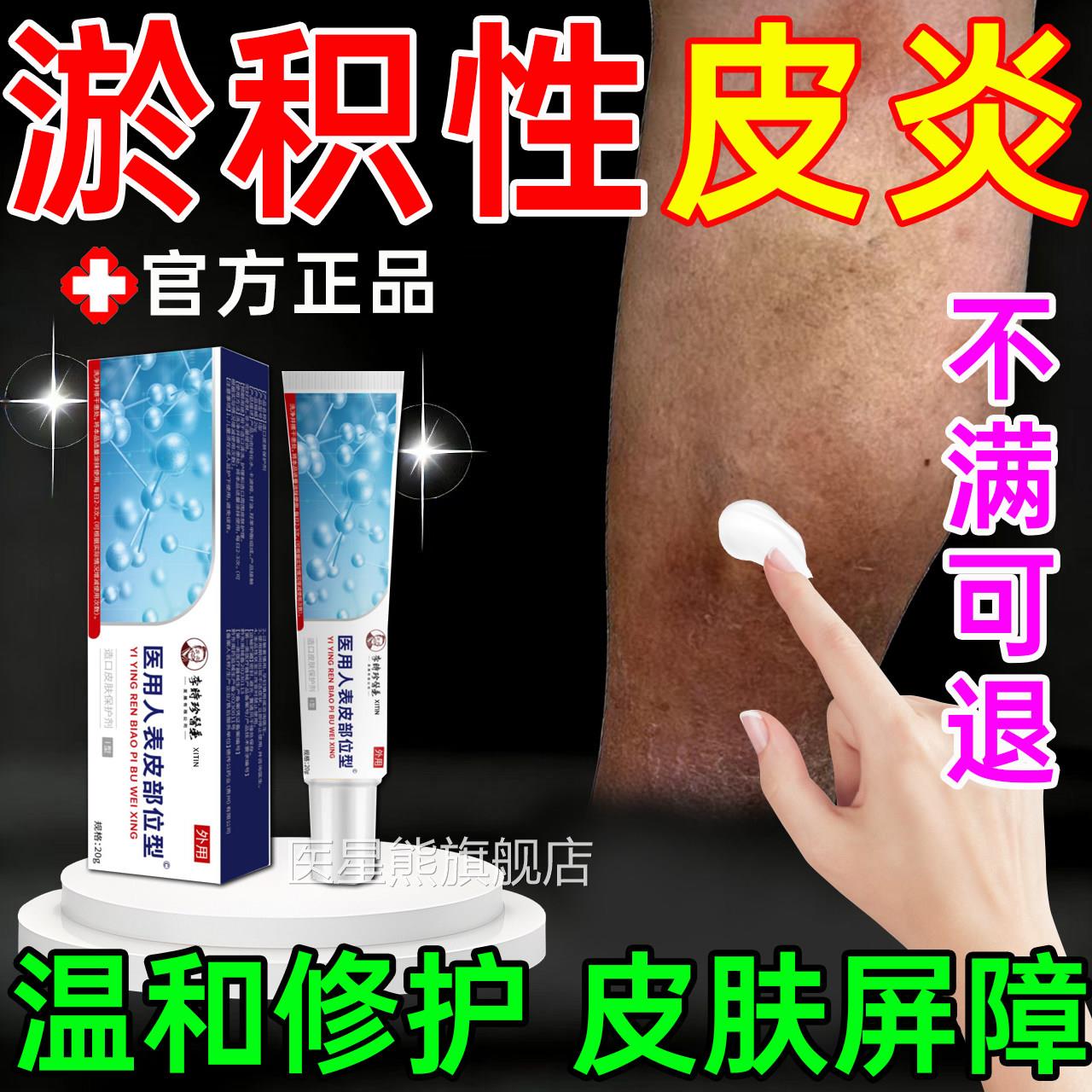 淤积性皮炎小腿发发紫瘙痒红肿静脉曲张静脉炎湿疹专用修复黑膏PP