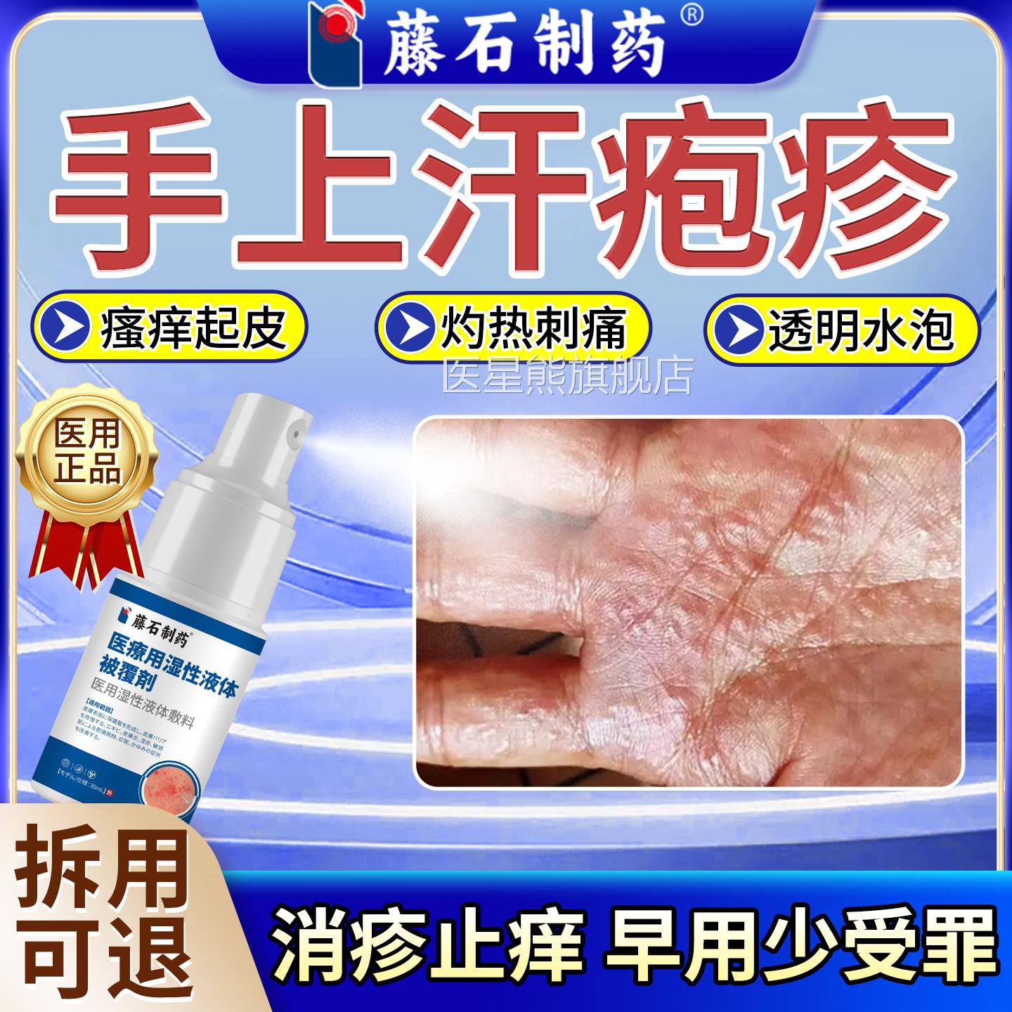 汗疱疹手上起小水泡感止痒喷剂湿疹真菌染瘙痒脱皮抑菌药房同售SA