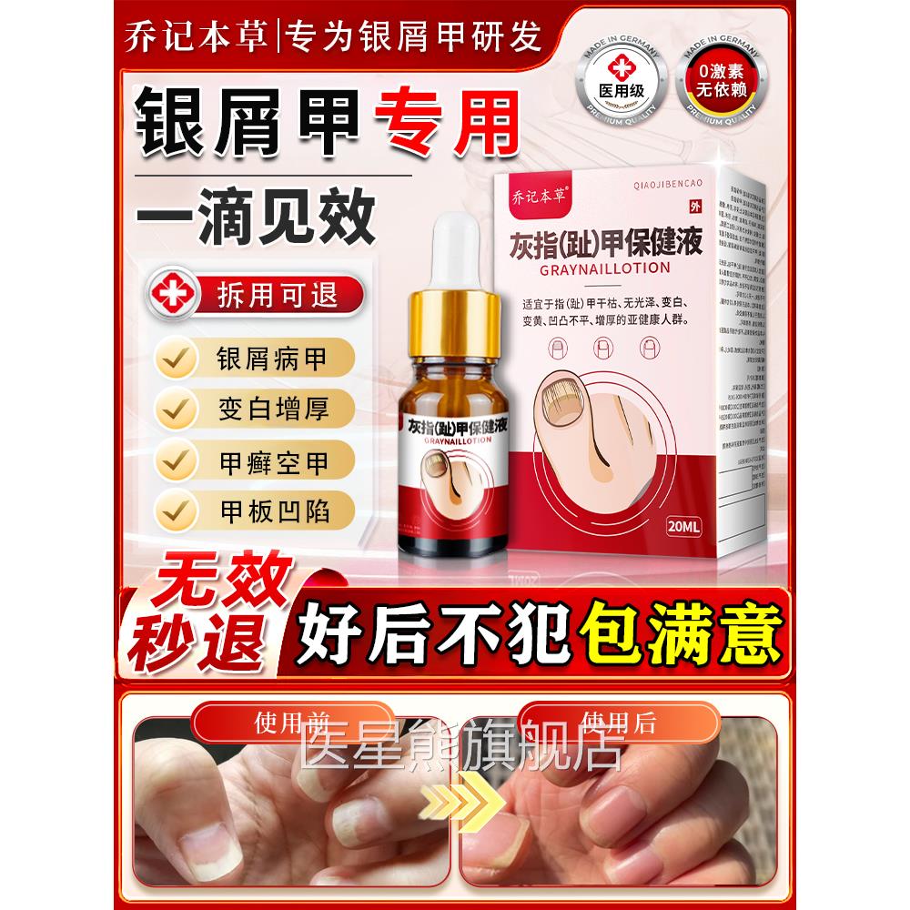 银屑病甲手脚指甲真菌感染蜂窝状牛皮甲癣灰指发甲黄增厚专用膏药