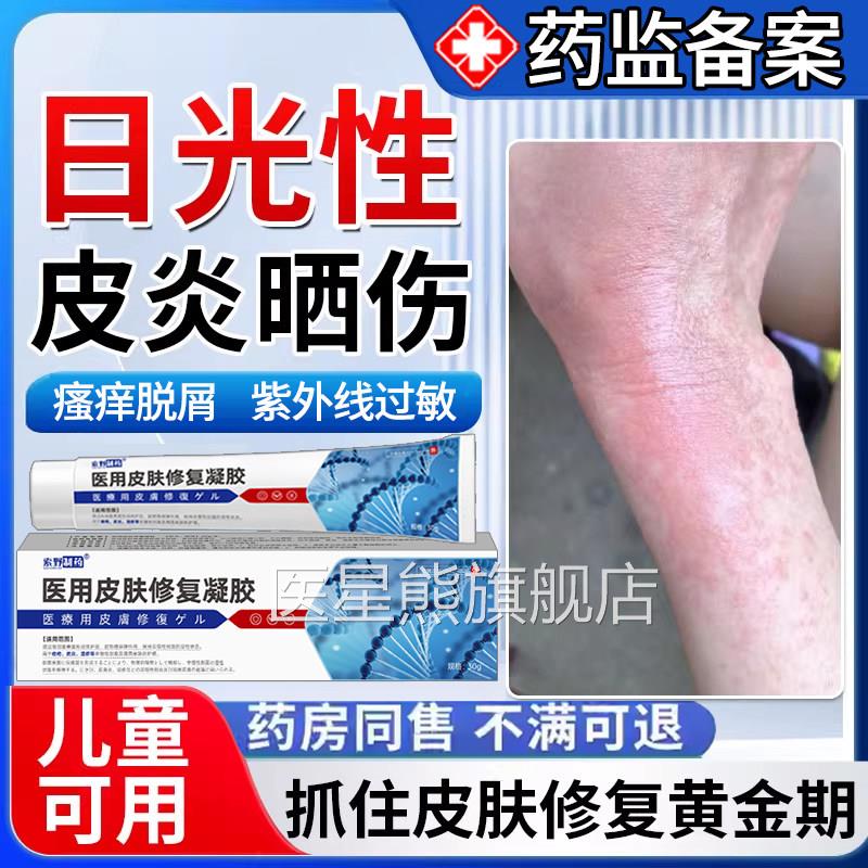 日光性皮炎紫外线过敏瘙发痒太阳伤皮肤修复霜晒专用药房同款膏Y7