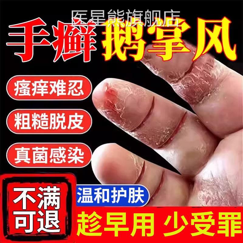 手癣膏脱皮干裂真菌感染烂手足癣药房同售角化型湿疹去掌鹅风根CA